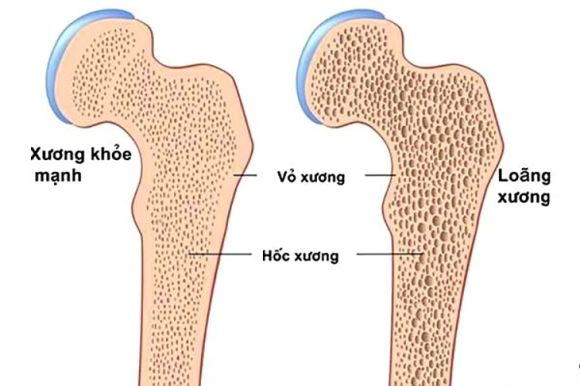 Bí Quyết Ngăn Ngừa Loãng Xương Từ Sớm: Uống Sữa Đã Đủ Chưa?