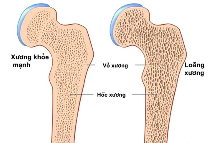 Bí Quyết Ngăn Ngừa Loãng Xương Từ Sớm: Uống Sữa Đã Đủ Chưa?